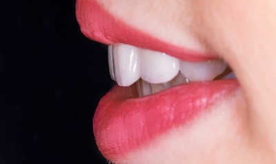 美齒貼片 美齒貼片