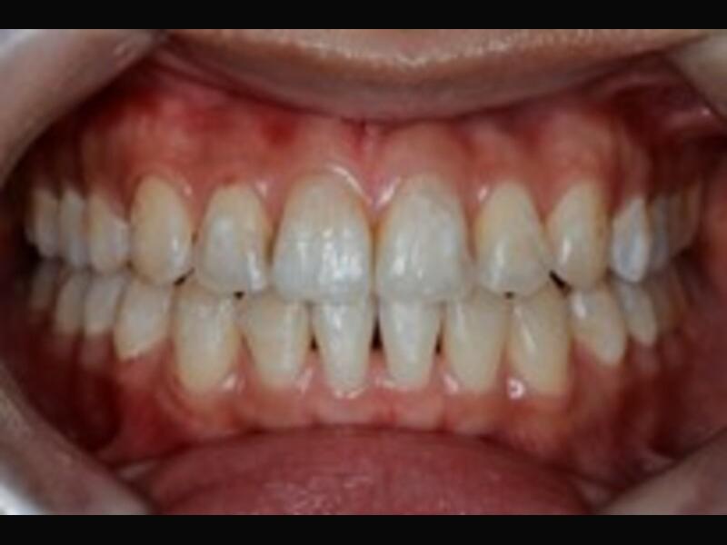 隱形矯正(青少年案例)