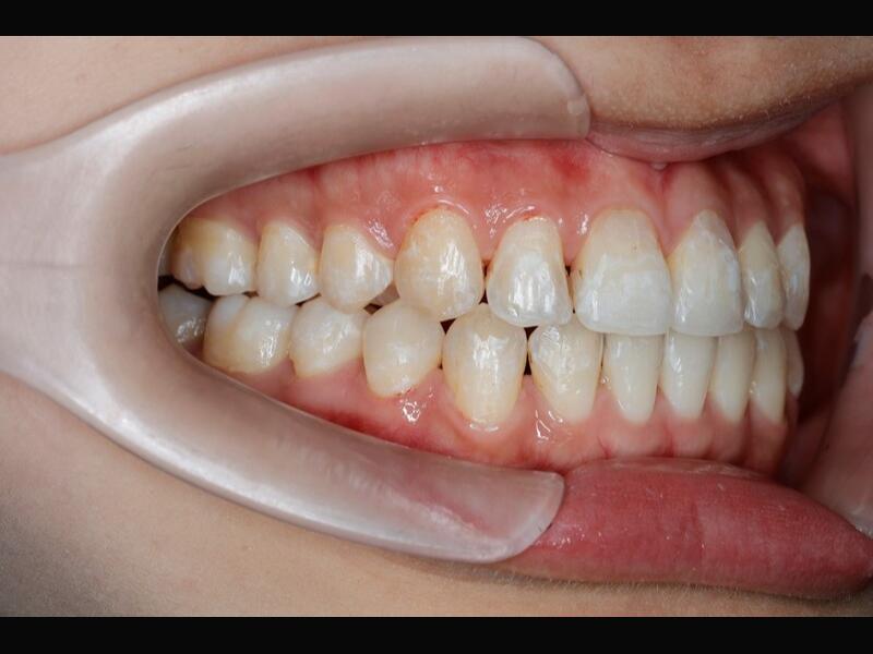 隱形矯正(青少年案例)