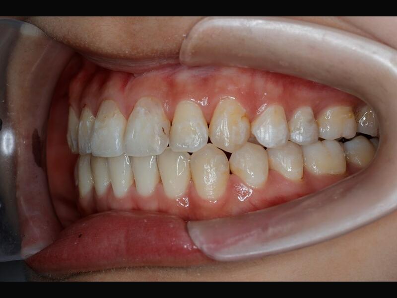 隱形矯正(青少年案例)