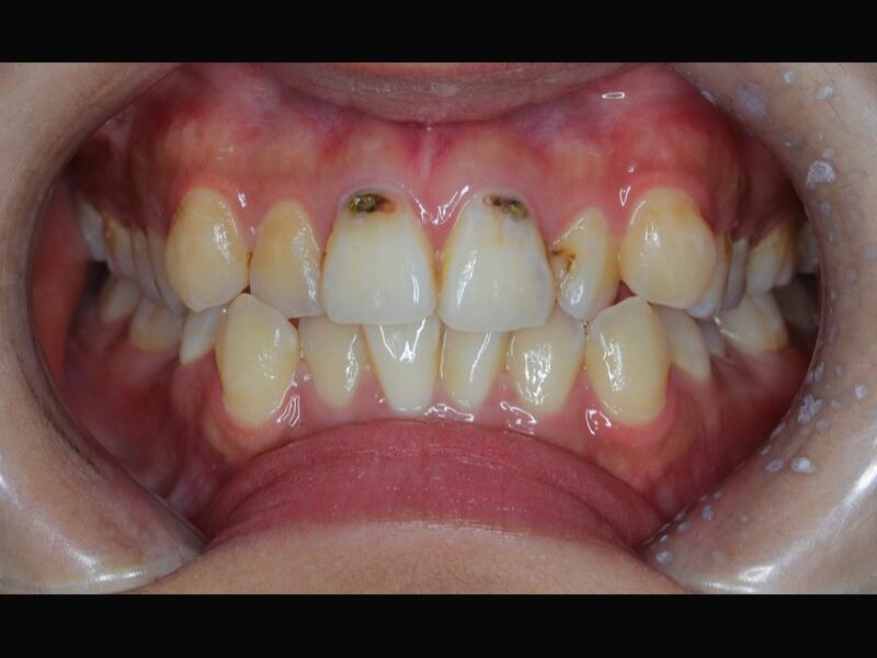 隱形矯正(青少年案例)