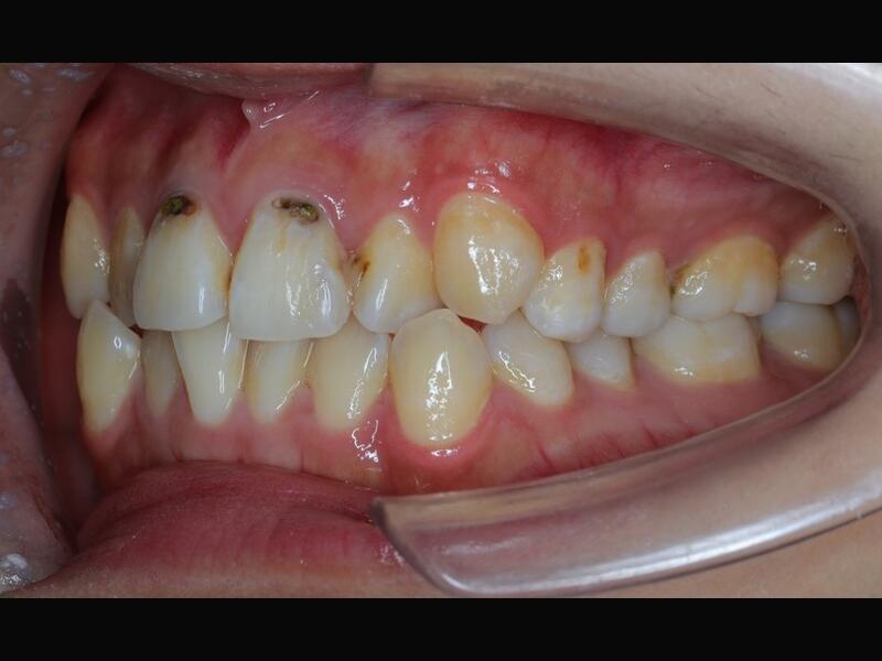 隱形矯正(青少年案例)