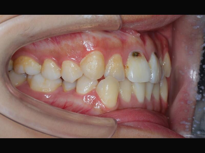 隱形矯正(青少年案例)