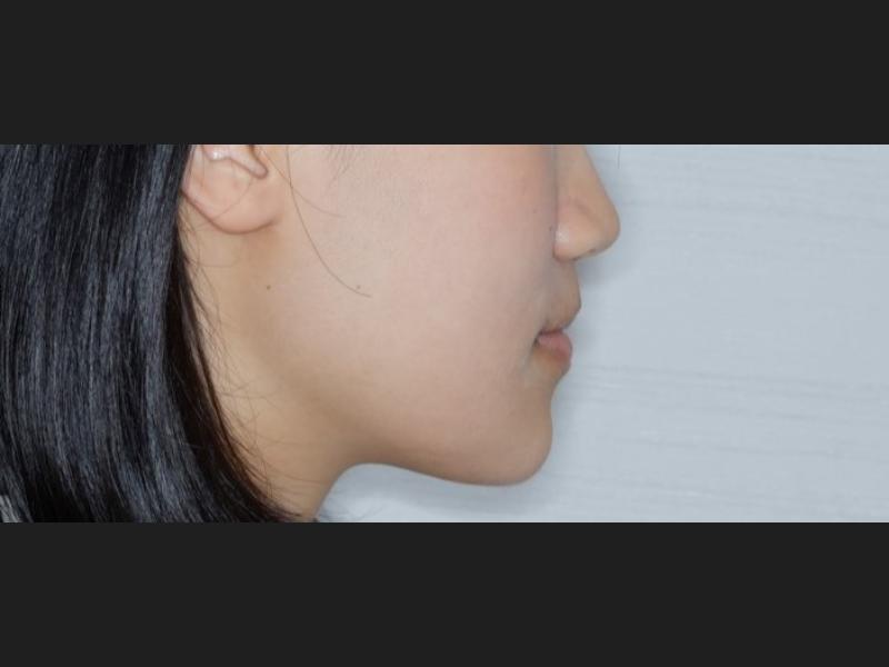 隱形矯正(青少年案例)