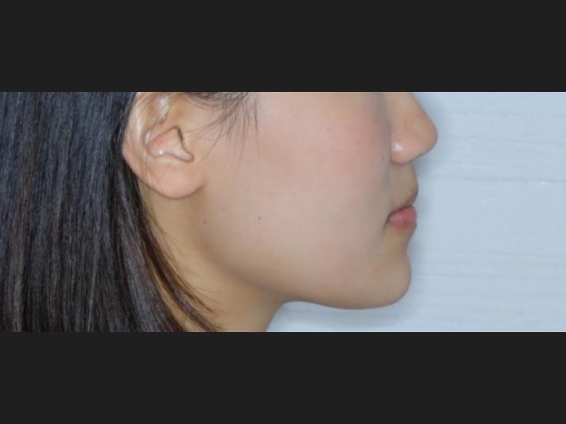 隱形矯正(青少年案例)