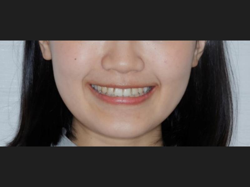 隱形矯正(青少年案例)