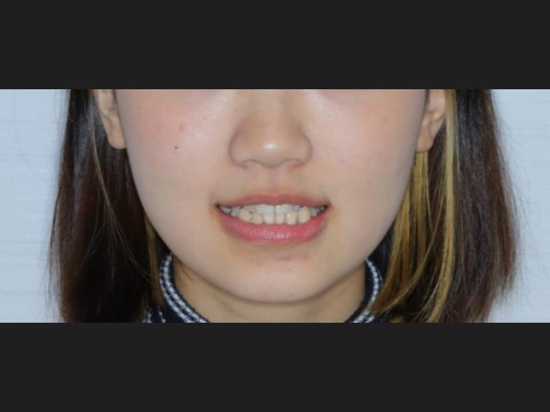 隱形矯正(青少年案例)