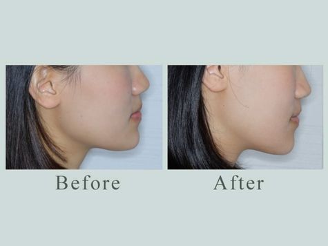 隱形矯正(青少年案例)