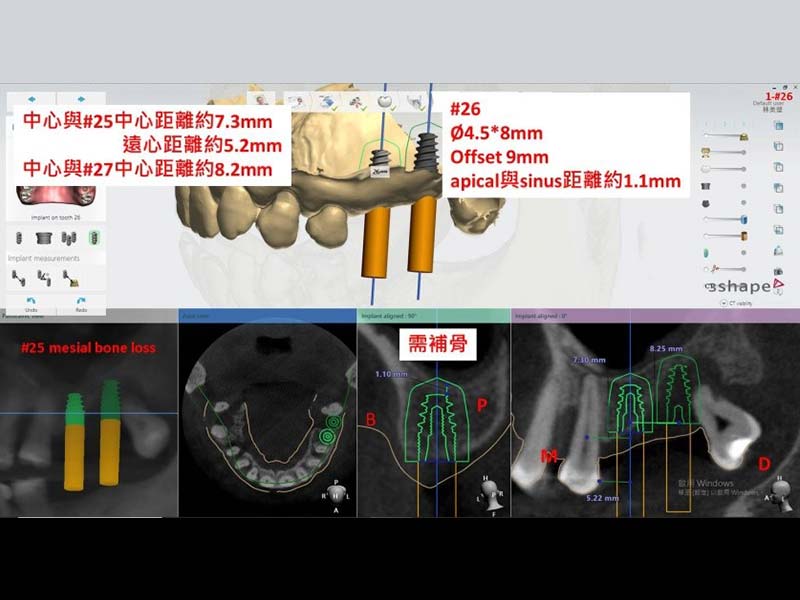 3D數位導航植牙 3D數位導航植牙